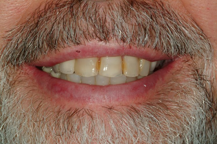 Before six ceramic crowns on the front teeth