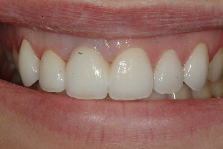 After a three-unit ceramic dental bridge