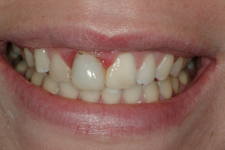 Before a three-unit ceramic dental bridge