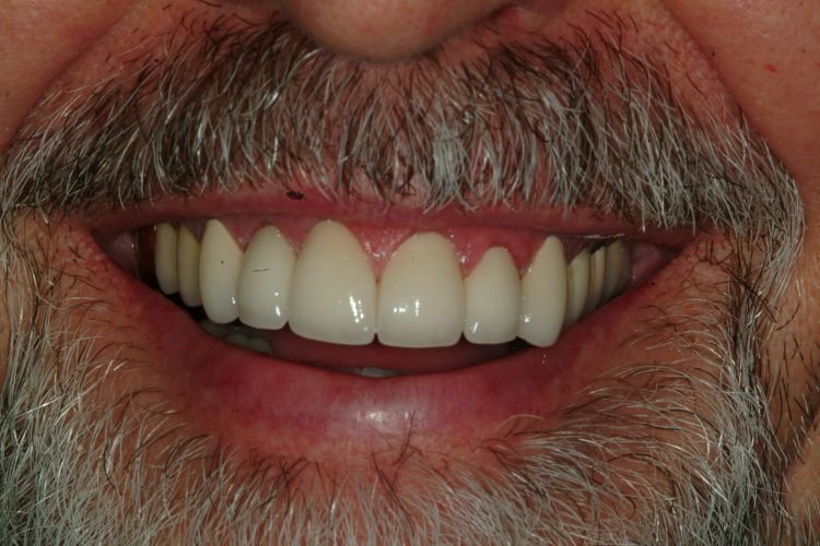 After six ceramic crowns on the front teeth