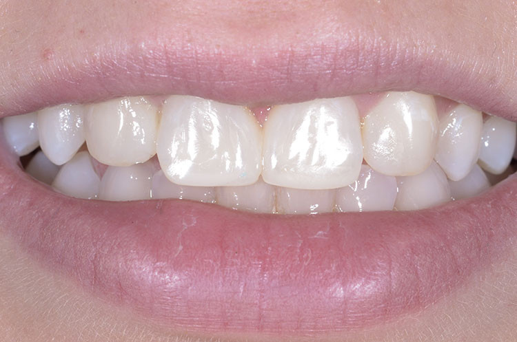 After diastema closure