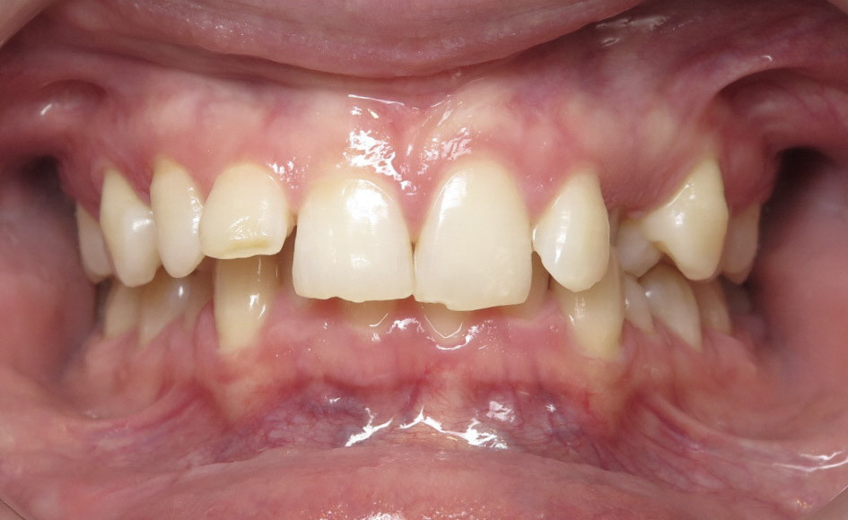 Before six front crowns following orthodontics