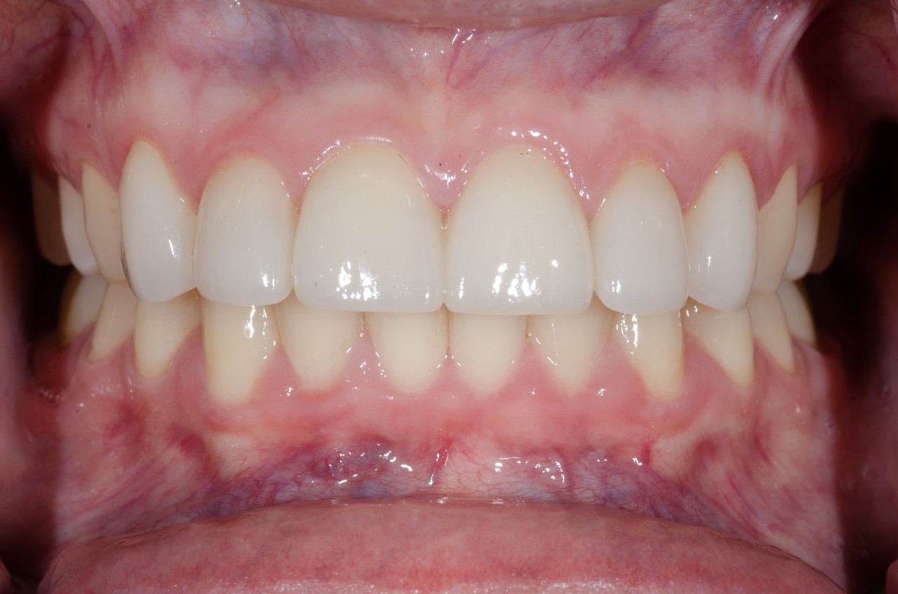 After six front crowns following orthodontics