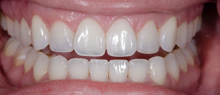 After lateral tooth bonding