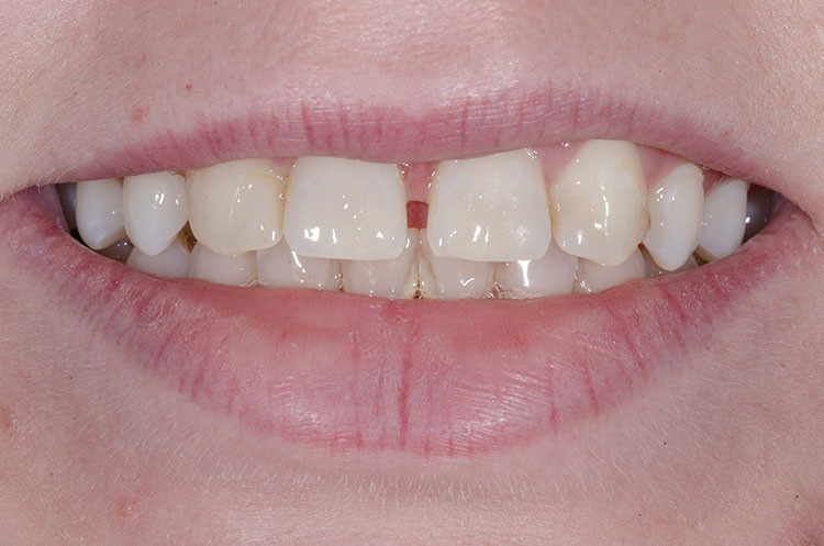 Before diastema closure