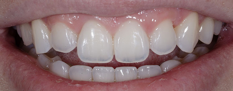 Before lateral tooth bonding