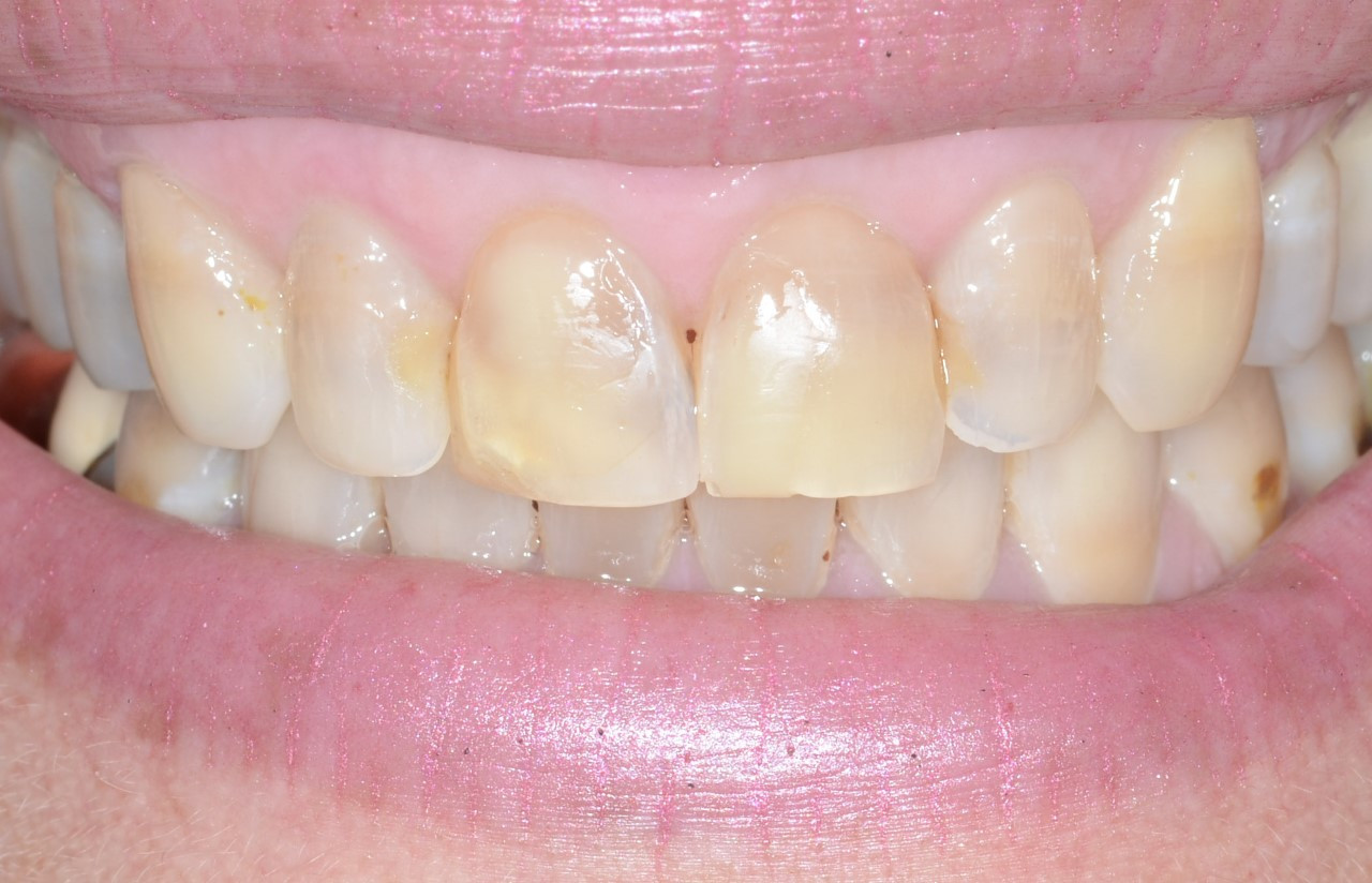 Before upper and lower dental crowns