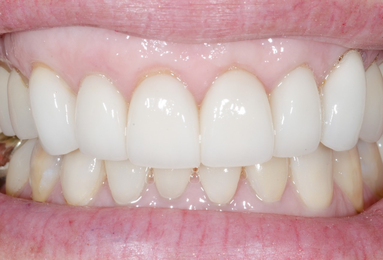 After upper and lower dental crowns