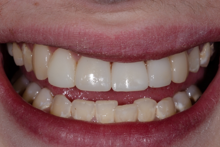 After direct injection composite treatment