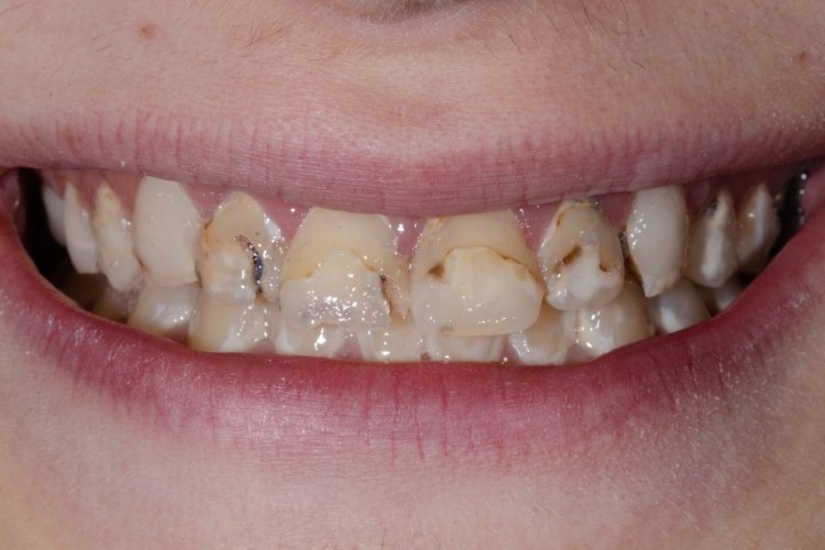 Before direct injection composite treatment