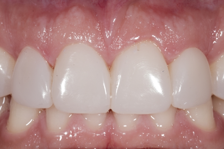 After composite treatment to close a tooth gap