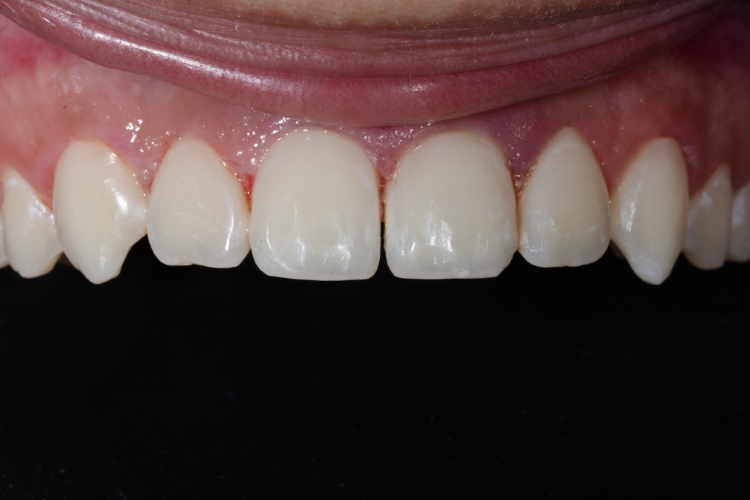 After direct bonding on the front teeth