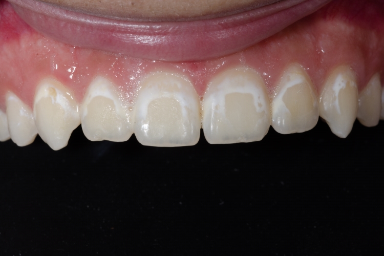 Before direct bonding on the front teeth