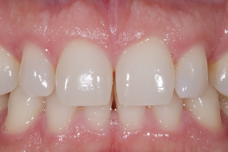 Before composite treatment to close a tooth gap
