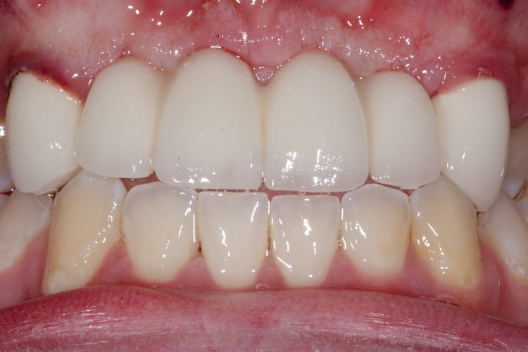 After six-unit dental bridge treatment