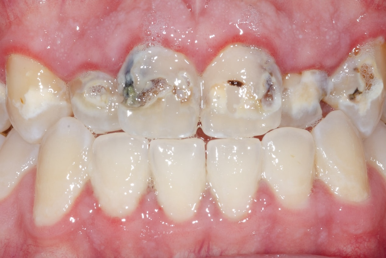 Before six-unit dental bridge treatment