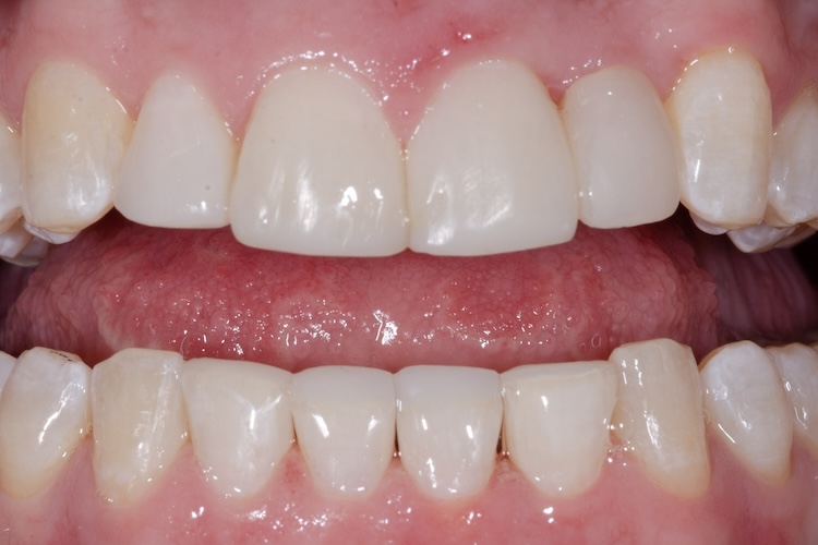 After a dental crown and upper and lower tooth bonding