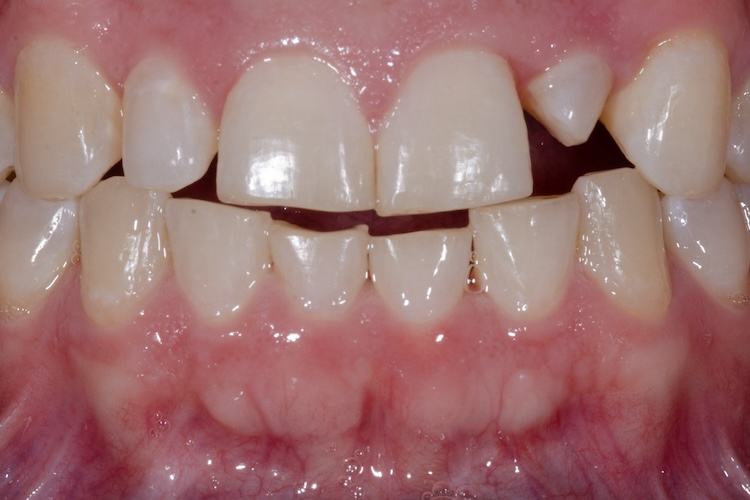 Before a dental crown and upper and lower tooth bonding