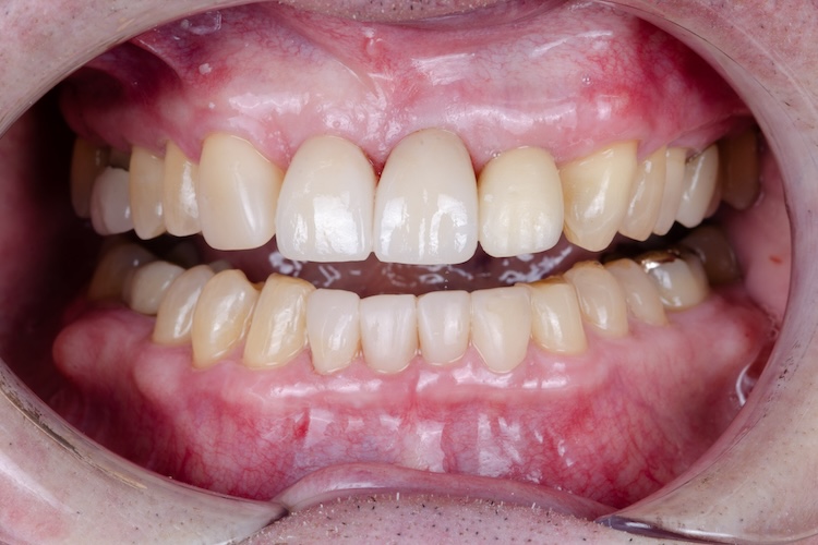 After orthodontics, two crowns, and composite bonding