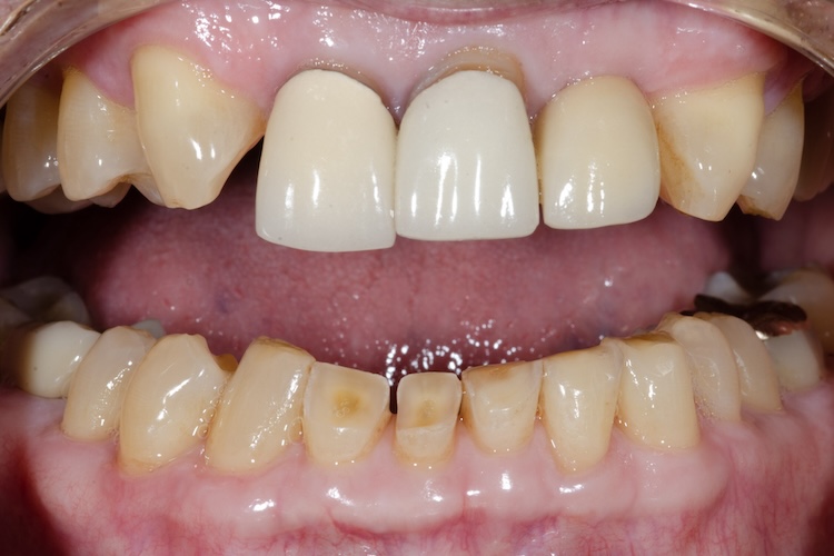 Before orthodontics, two crowns, and composite bonding