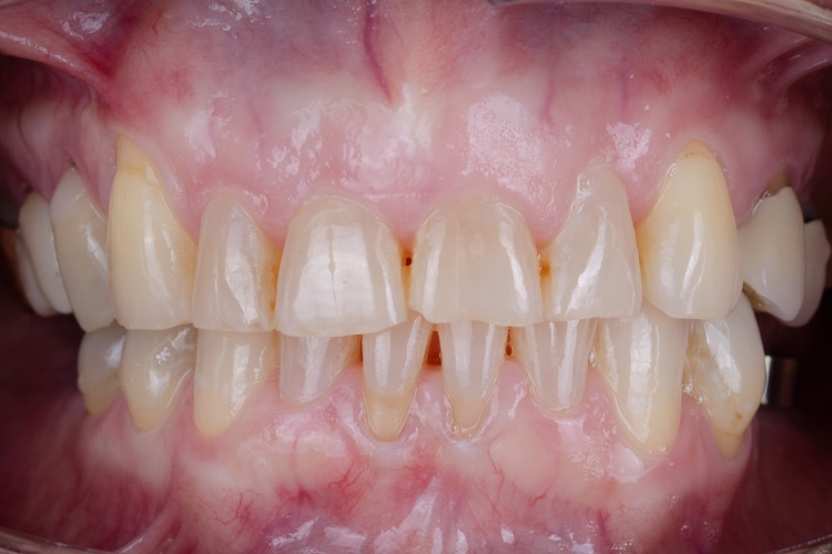 Before full mouth reconstruction